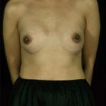 Breast Augmentation Before & After Patient #8144