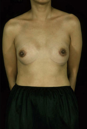 Breast Augmentation Before & After Patient #8144