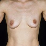 Breast Augmentation Before & After Patient #8149