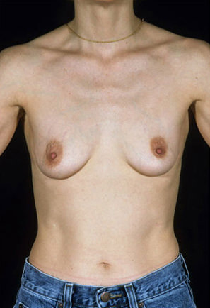 Breast Augmentation Before & After Patient #8149