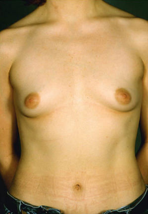 Breast Augmentation Before & After Patient #8154