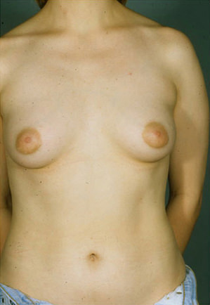 Breast Augmentation Before & After Patient #8154