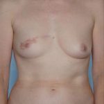 Breast Augmentation Before & After Patient #8159
