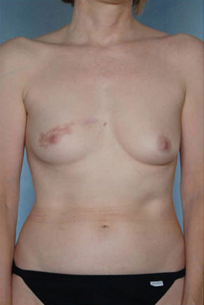 Breast Augmentation Before & After Patient #8159