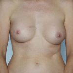 Breast Augmentation Before & After Patient #8159