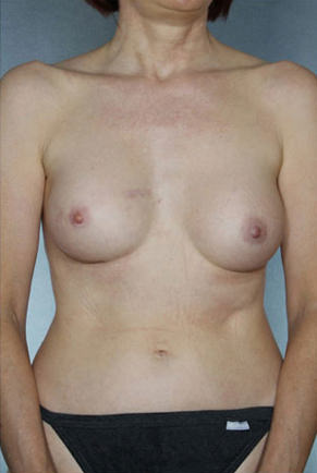 Breast Augmentation Before & After Patient #8159