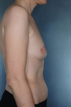 Breast Augmentation Before & After Patient #8159