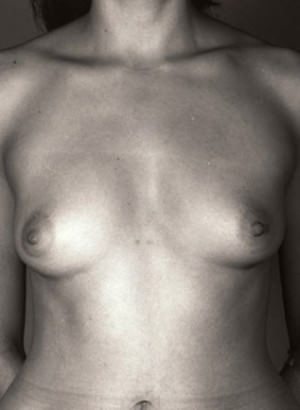 Breast Augmentation Before & After Patient #8164