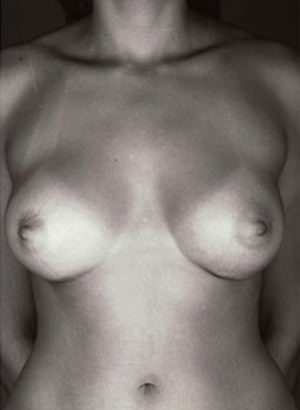 Breast Augmentation Before & After Patient #8164