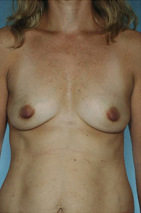 Breast Augmentation Before & After Patient #8169