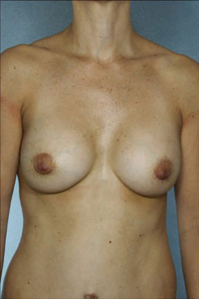 Breast Augmentation Before & After Patient #8169
