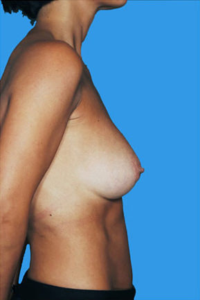 Breast Augmentation Before & After Patient #8174