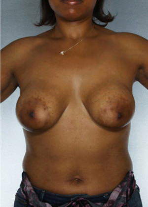 Breast Augmentation Before & After Patient #8179