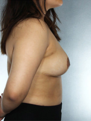 Breast Lift Before & After Patient #8438