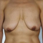 Breast Lift Before & After Patient #8448