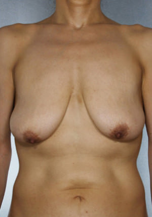 Breast Lift Before & After Patient #8448