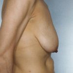 Breast Lift Before & After Patient #8448