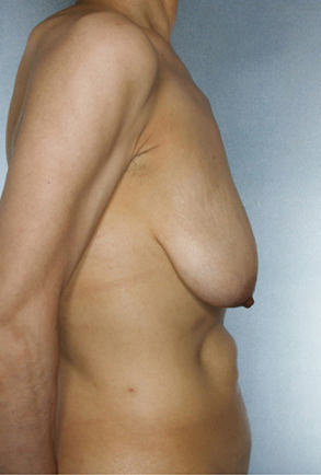 Breast Lift Before & After Patient #8448