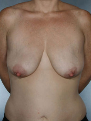 Breast Lift Before & After Patient #8453