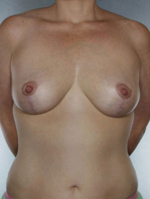 Breast Lift Before & After Patient #8453