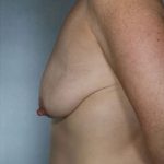 Breast Lift Before & After Patient #8453