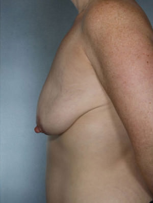 Breast Lift Before & After Patient #8453