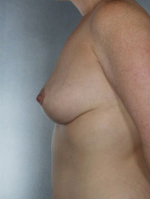 Breast Lift Before & After Patient #8453