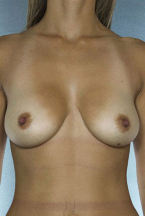 Breast Lift Before & After Patient #8458