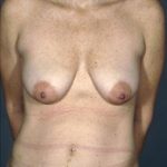 Breast Lift Before & After Patient #8469