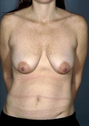 Breast Lift Before & After Patient #8469