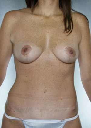 Breast Lift Before & After Patient #8469