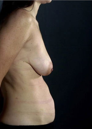 Breast Lift Before & After Patient #8469