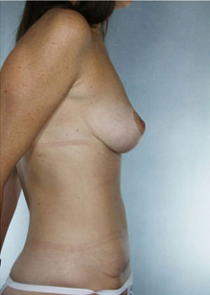 Breast Lift Before & After Patient #8469
