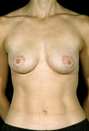 Breast Lift Before & After Patient #8474