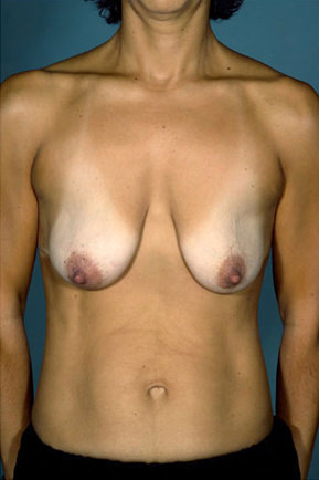 Breast Lift Before & After Patient #8479