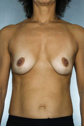 Breast Lift Before & After Patient #8479