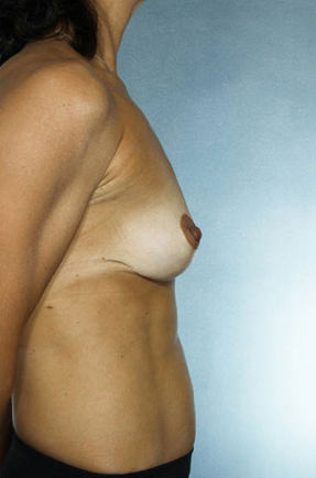 Breast Lift Before & After Patient #8479