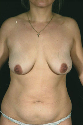 Breast Lift Before & After Patient #8489
