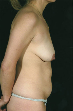 Breast Lift Before & After Patient #8489