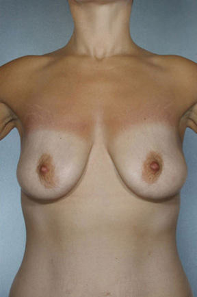 Breast Lift Before & After Patient #8494