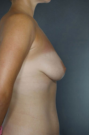 Breast Lift Before & After Patient #8494