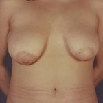 Breast Lift Before & After Patient #8201