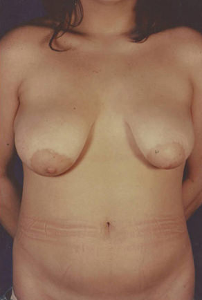 Breast Lift Before & After Patient #8201