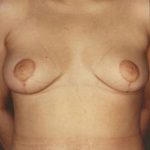 Breast Lift Before & After Patient #8201