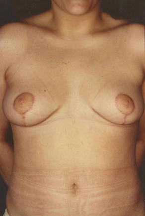 Breast Lift Before & After Patient #8201