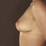 Breast Lift Before & After Patient #8201