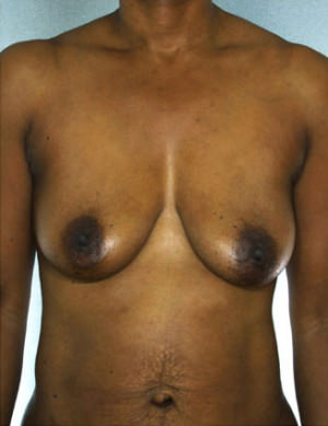 Breast Lift Before & After Patient #8208