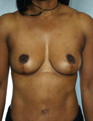 Breast Lift Before & After Patient #8208