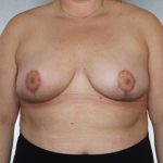 Breast Reduction Before & After Patient #8350