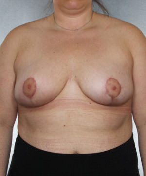 Breast Reduction Before & After Patient #8350